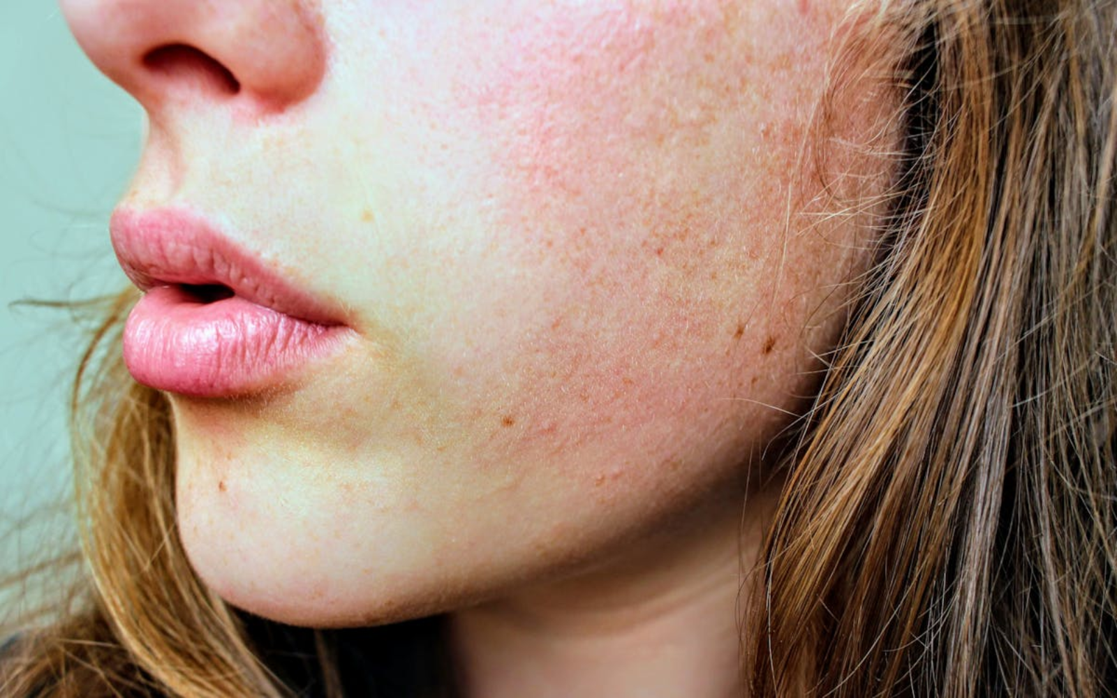 acne face map