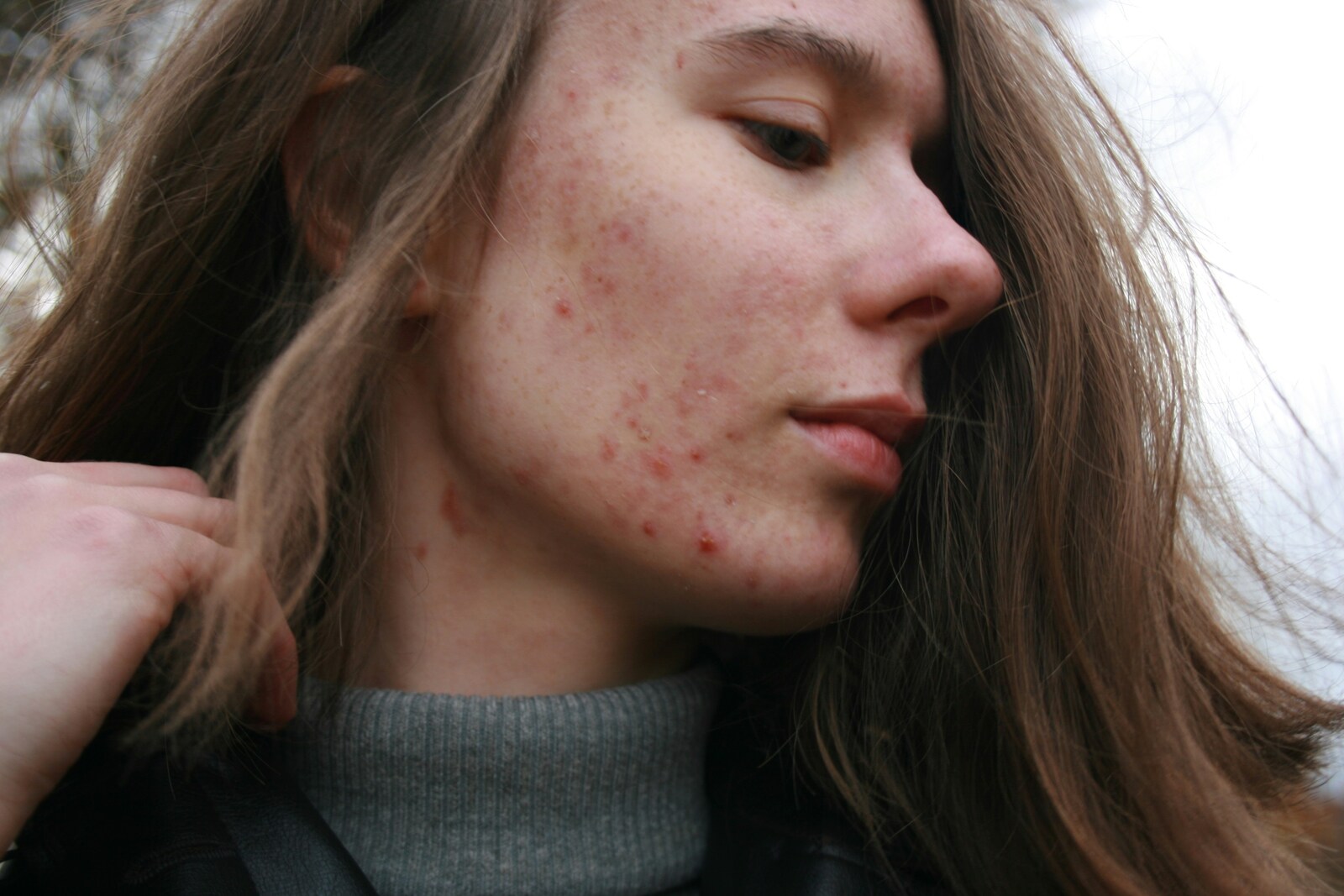 stress acne on face