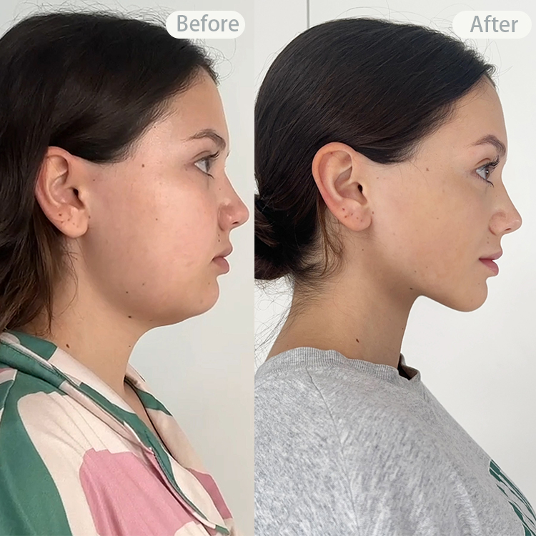 Face Workouts Before And After Face Workouts Before And After