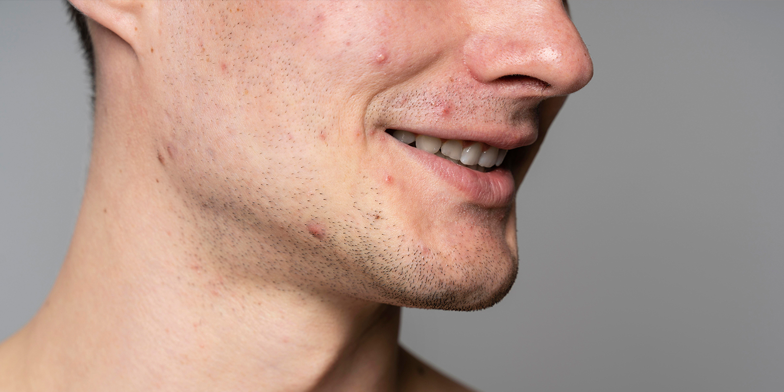 acne on chin