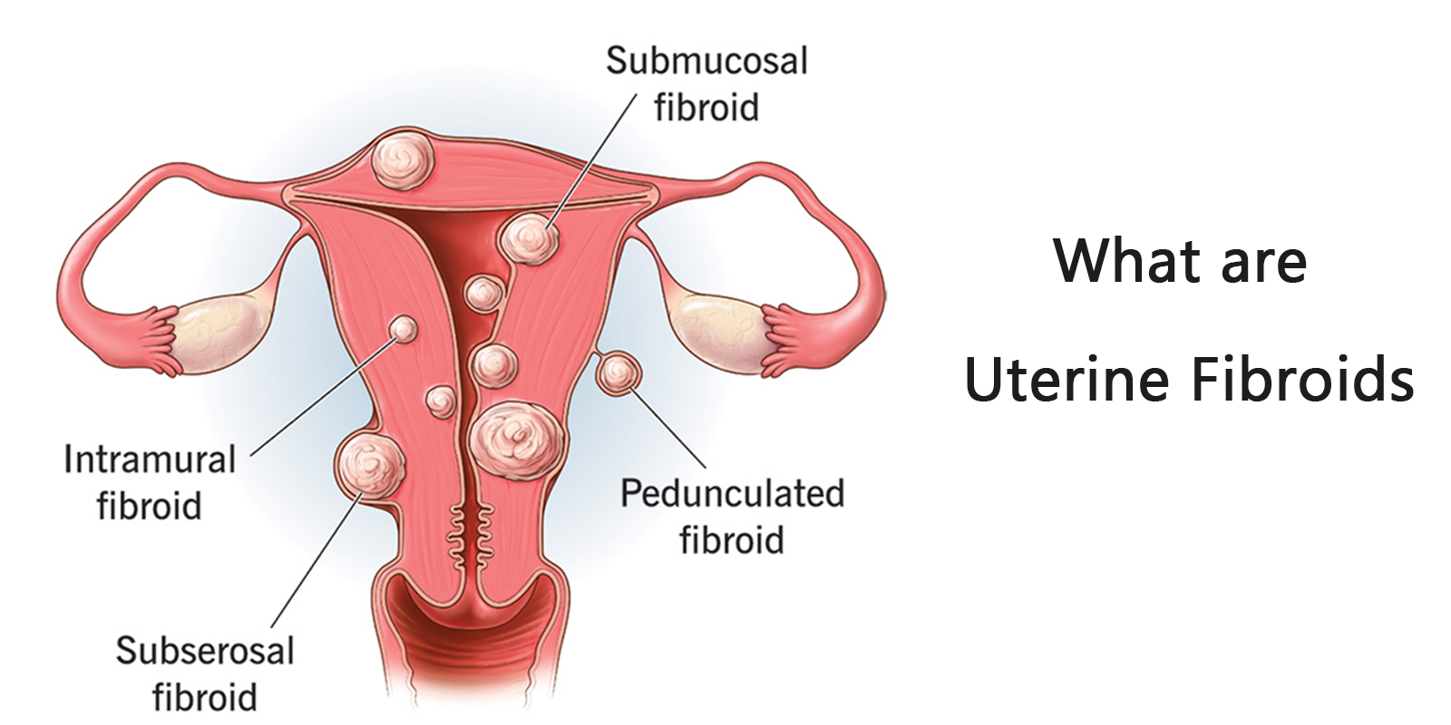 what are uterine fibroids